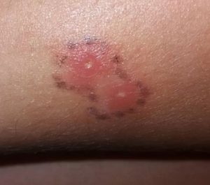 mordedura vibora ejemplo foto